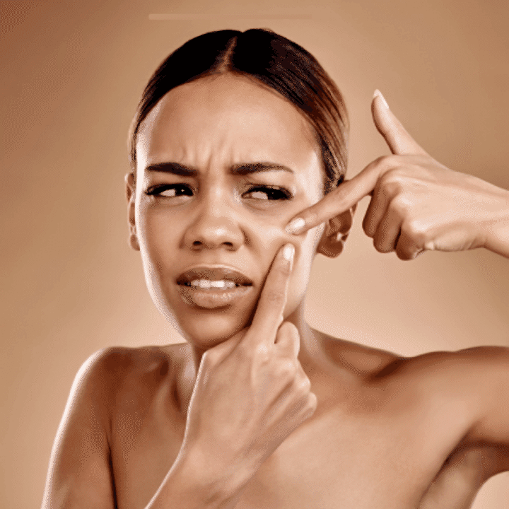 Komedon Nedir? Komedona Sebep Olan İçerikler Nelerdir?